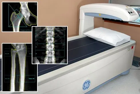 Dexa Bone Densitometry